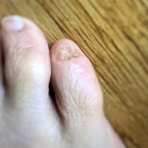ジャンク スムーズに ゴール 足 の 小指 の 爪 白い Omutamachikyo Jp