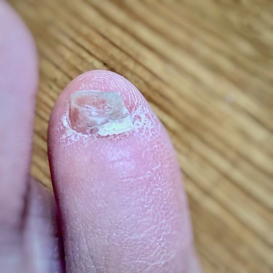 【実録】小さくて醜すぎる足の小指の爪を、本気できれいに伸ばす方法【異常に変形】